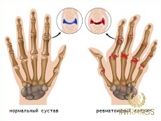 Фото здоровой руки и руки, пораженной артритом